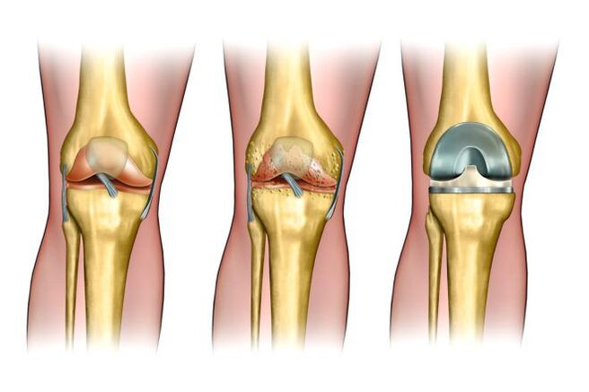 Degré d'arthrose