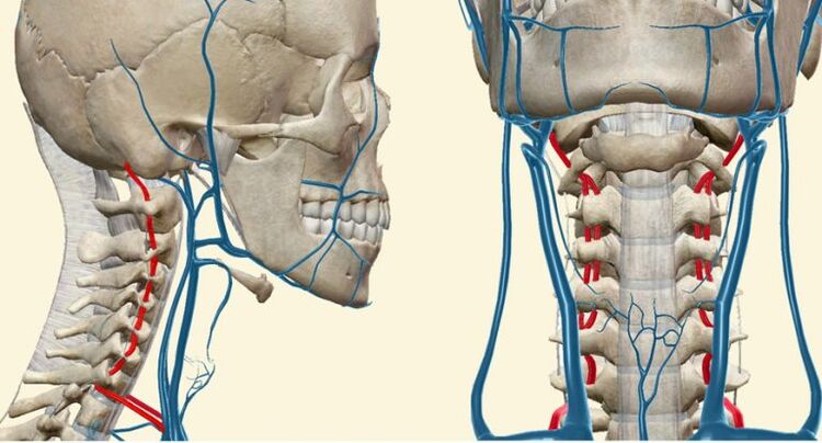 Syndrome vasculaire dans l'ostéochondrose