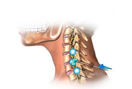 Traitement de l'ostéochondrose cervicale